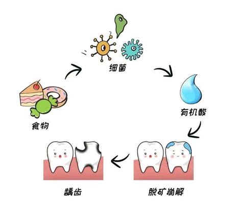 嘴巴生虫|龋齿（牙齿细菌性疾病）